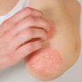 What Is Psoriasis? Dermatologists Break Down the Skin Condition