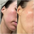 WTF Is Contact Dermatitis? I Asked an Expert For Tips That Actually Work